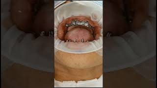 Maxillary cement retained titanium bar for full arch basal implants checking gum impingement [upl. by Ysus7]