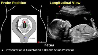 Obstetric Ultrasound Probe Positioning  Pregnant Uterus amp Fetus Transducer Placement USG Scan [upl. by Comptom88]