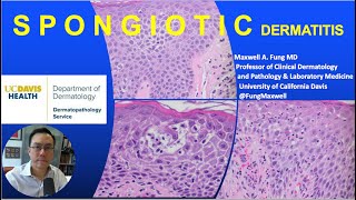 DERMATOPATHOLOGY Spongiotic Dermatitis [upl. by Berger]