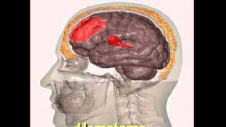 Como Se Lesiona el Cerebro Una Fuerza Positiva Modulo 3 [upl. by Sacttler]