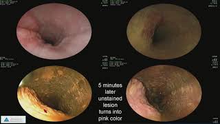 Early Detection of Esophageal Cancer and Barrett’s Esophagus Recent Advances [upl. by Notle707]