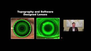 Using the MOONLENS® and KATTCloud™ Platform for Automated and Efficient Myopia Management [upl. by Ibrad901]