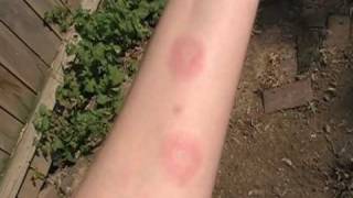 Erythema Nodosum [upl. by Annette902]