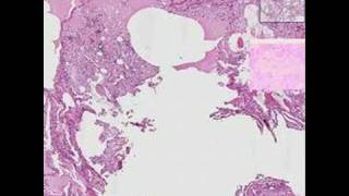 Histopathology Lung  Aspiration pneumonia [upl. by Avigdor516]