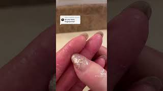 Do I have fingerprints Epidermolytic Palmoplantar Keratoderma  Jan 20 2023 [upl. by Aneroc]