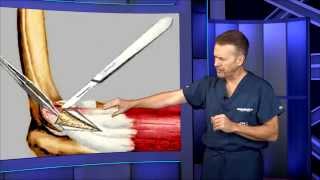 Tennis Elbow Surgery [upl. by Eelannej]