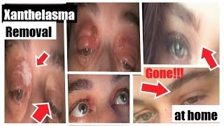 Xanthelasma Removal at Home With Wartner Pen My Subscribers Amazing Results Before amp After Photos [upl. by Eyllom]