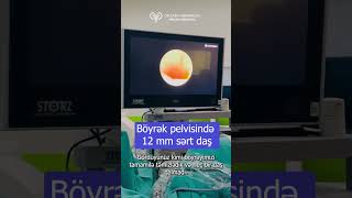 Böyrək daşı əməliyyatı Retrograde İntrarenal Surgery RİRS uroloq androloq [upl. by Eveivenej]