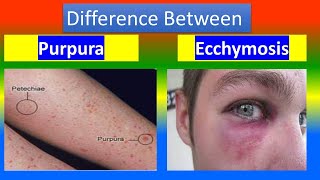 PURPURA Vs ECCHYMOSIS [upl. by Eirellam186]