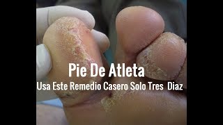 Como Curar El Pie De Atleta 5 Remedios Caseros [upl. by Etiam]