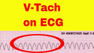 Ventricular Tachycardia on ECG [upl. by Engelhart]