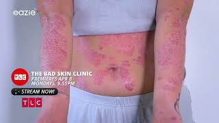 Mystery Bumps amp Rashes 😱👩‍⚕️💼  The Bad Skin Clinic  Eazie TV [upl. by Elladine]