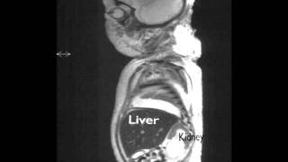 Zellweger Syndrome [upl. by Nikolas]