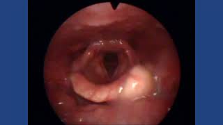 Epiglottic Cyst [upl. by Adnoryt]