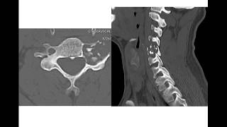 Bone Tumors  Tumors not in long bones Basic Radiology [upl. by Attennaj]