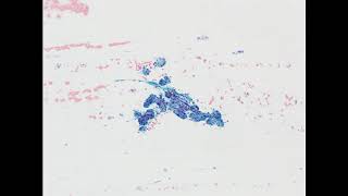 Parotid mass Acinic cell carcinoma Alcoholfixed smear [upl. by Nalyd]