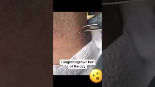 Long ingrown hair satisfyingvideo relax [upl. by Assilaj]