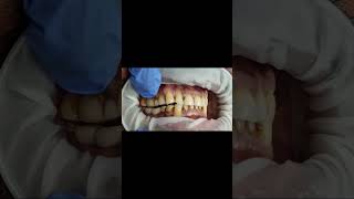 Lower implant molar bridge bite check with Bausch 40 micron articulating paper test shorts [upl. by Yniatirb]