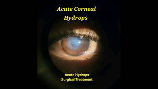 Acute Corneal Hydrops Surgical Draining [upl. by Dulcie]