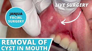 REMOVAL OF CYST IN MOUTH LIVE SURGERY  DR TANVEER JANJUA  NEW JERSEY [upl. by Seto260]