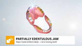 SICAT CLASSICGUIDE  1 to 2 missing teeth  major metal artifacts [upl. by Niko387]