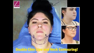 Double Chin Liposuction with Neck Contouring Wide Awake Local Anesthesia InOffice and QUICK [upl. by Limemann]