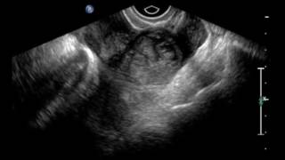 Ectopic Pregnancy Ultrasound JETem 2016 [upl. by Halsted]