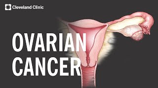 5 Warning Signs and Risk Factors of Ovarian Cancer [upl. by Groh822]