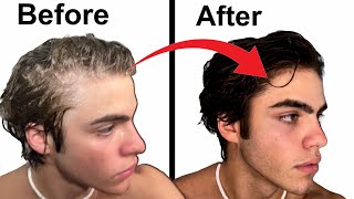 How To Stop Balding  Full hair loss guide [upl. by Collete]