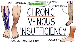 Understanding Chronic Venous Insufficiency [upl. by Meean]