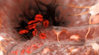 Hemorrhagic Stroke Brain Hemorrhage [upl. by Zzabahs]