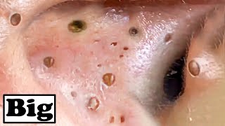 Super Removal Blackheads In Ear [upl. by Adna]