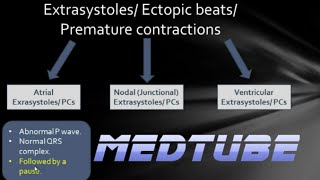 ECGs abnormal rhythms Extrasystoles [upl. by Yrakaz]