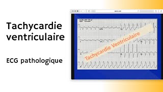 Tachycardie ventriculaire  ECG pathologique  arythmie [upl. by Mateo]