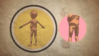 Child Malnutrition  What How And when to Refer [upl. by Dalli]