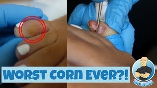 Surprise Surgical Removal of Abnormal Foot Corn UPDATED VERSION [upl. by Akiehsal646]