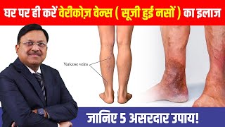 घर पर ही करें वेरीकोज़ वेन्स का इलाज जानिए 5 असरदार उपाय  Home Remedies to Treat Varicose Veins [upl. by Cristian]