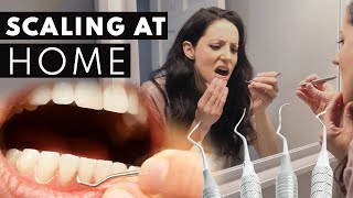 Scaling Your OWN Teeth At Home Here Is Why Its A BAD Idea [upl. by Asylem785]