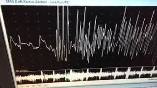 neuromyotonic discharges [upl. by Atrebor]