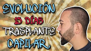 11 TRASPLANTE CAPILAR 15 días DESPUÉS  Evolución Injerto [upl. by Griffin]