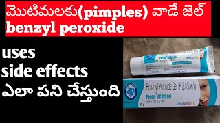 Benzoyl peroxide gel uses Telugupimplesacne treatment telugu [upl. by Mikal]