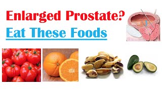 Best Foods to Eat with Enlarged Prostate  Reduce Risk of Symptoms Enlargement amp Cancer [upl. by Eerehc]