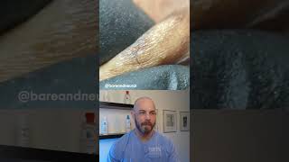 Ingrown hair frenzy ingrownhair dermreacts doctorreacts [upl. by Hogarth143]