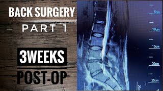 Back Surgery Laminectomy L4L5 Recovery part 1 [upl. by Otto]