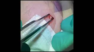 Tongue Biopsy Melanotic Macule [upl. by Ahsital]