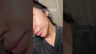 How my hormonal acne changes within 3 weeks of using turmeric soap skincare acnetreatment [upl. by Inaliel]