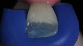 Ivoclar IPS Empress Direct – For highly aesthetic restorations [upl. by Chipman996]