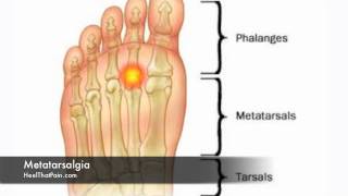 Metatarsalgia Foot Pain Causes Symptoms amp Treatments [upl. by Wollis]