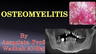 5 Osteomyelitis Dr Wadhah Oral Pathology lectures د وضاح الحاج [upl. by Aseyt]