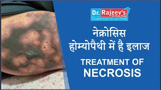 Homeopathic Medicine and Treatment for Necrosis Homoeopathic best Doctor for Necrosis [upl. by Ennovahc]